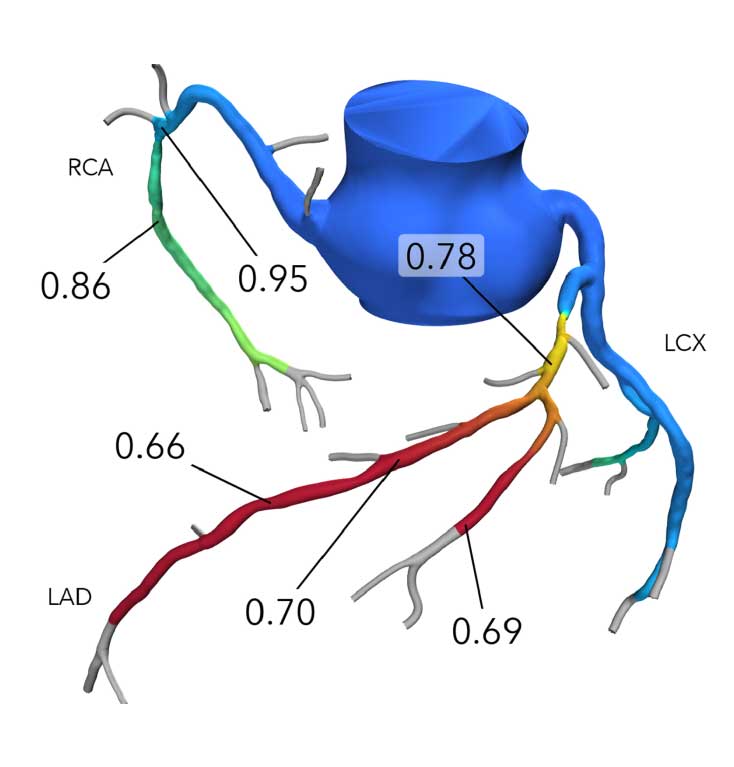 How FFRct Works diagram