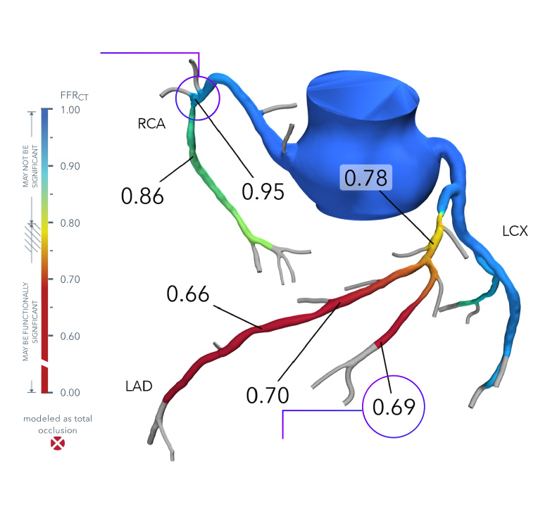 How FFRct Works diagram